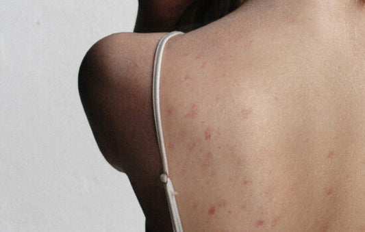A close-up of a person's back and shoulder, wearing a white bra strap, with visible red spots and blemishes on their skin.