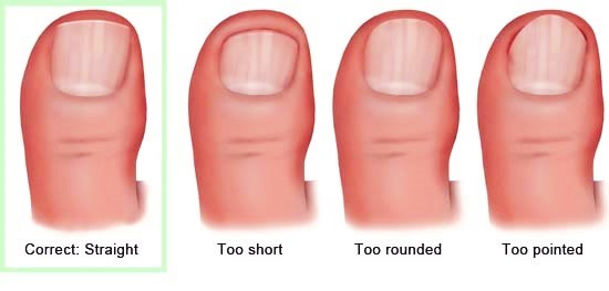 file your toenails to avoid ingrowns