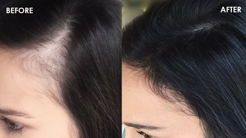 before and after covering hair loss